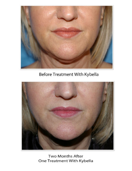 Results-of-Kybella-Treatment1