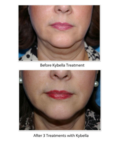 Results-of-Kybella-Treatment2