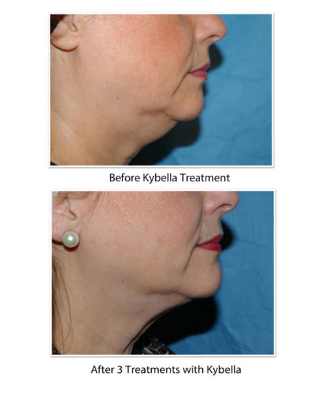 Results-of-Kybella-Treatment3