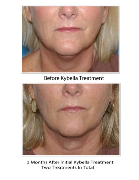 Results-of-Kybella-Treatment4