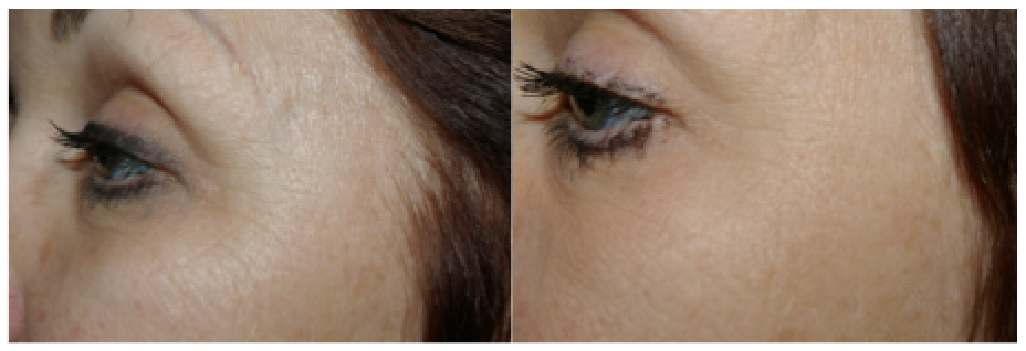 best-treatment-for-eye-wrinkles